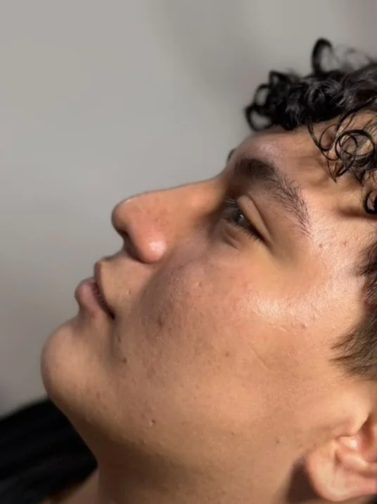Perfil antes de la armonización facial con ácido hialurónico en Esthetic DM Mérida, caso 1