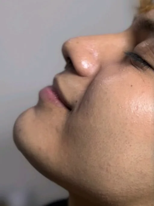 Perfil antes de la armonización facial con ácido hialurónico en Esthetic DM Mérida, caso 2