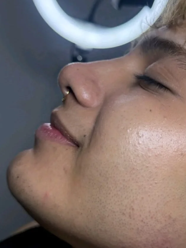 Perfil después de la armonización facial con ácido hialurónico en Esthetic DM Mérida, caso 2