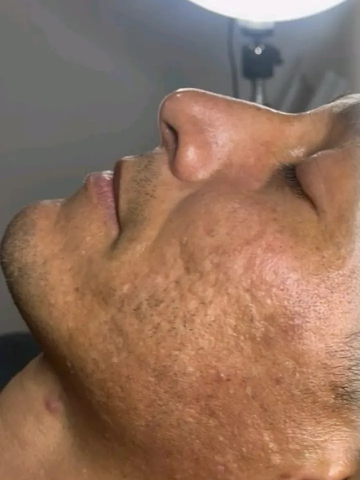Perfil nasal de un paciente antes de la rinomodelación con ácido hialurónico en Esthetic DM Mérida, caso 3
