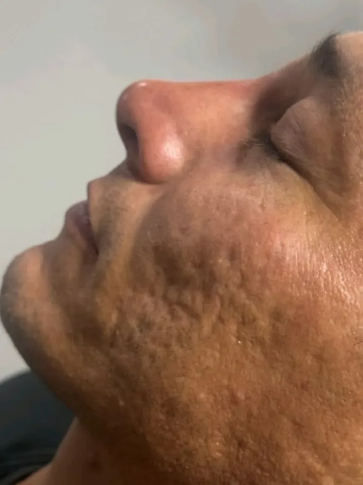 Perfil nasal de un paciente después de la rinomodelación con ácido hialurónico en Esthetic DM Mérida, caso 3