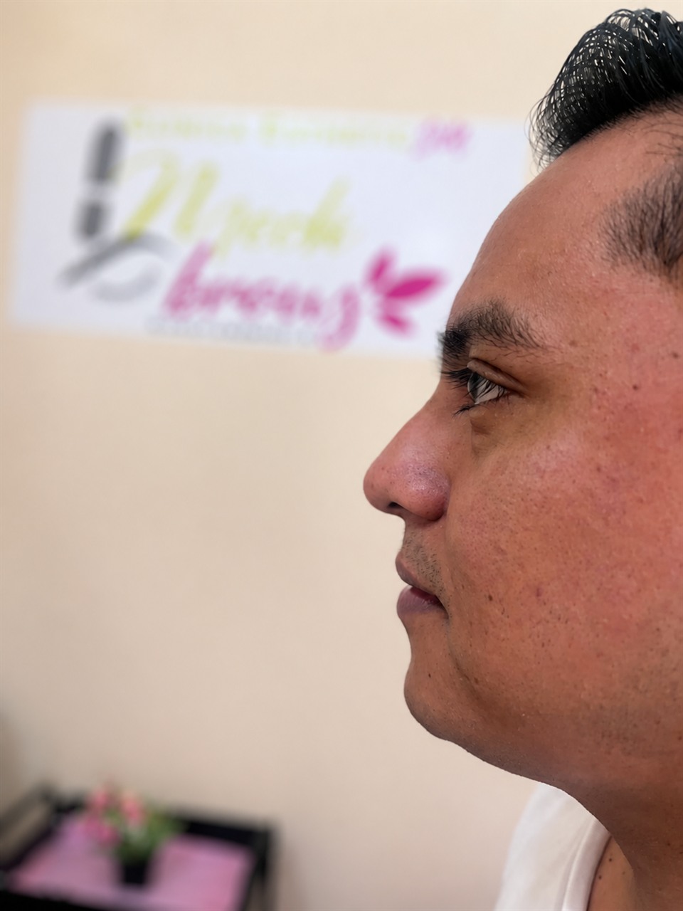 Perfil nasal antes de la rinomodelación en Esthetic DM Mérida