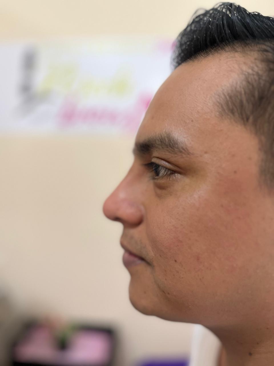 Perfil nasal después de la rinomodelación en Esthetic DM Mérida